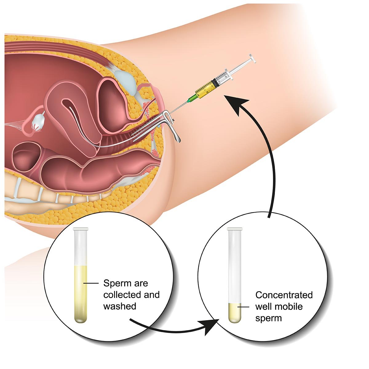 IUI Vs IVF - What’s The Difference - A Doctor Explains 02